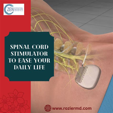 Spinal Cord Stimulator To Ease your Daily Life in Mansfield, Tx