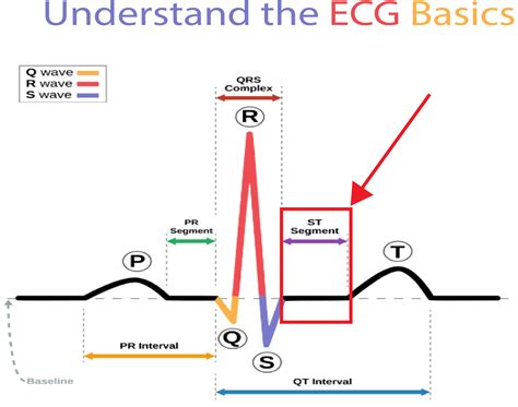 Interpreting ST elevations on an ECG (electrocardiogram) - Empower ...