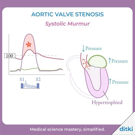 Clinical Pathology Glossary: Heart Murmurs - Stenosis & Regurgitation