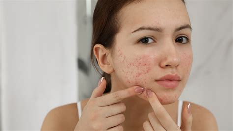 Natural Remedies for Acne: Complete Ayurvedic Solution for Clear, Blem ...