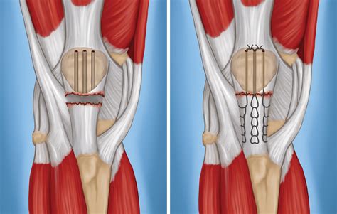 Patellar Tendon Graft