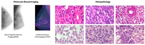 AI-Driven Breast Cancer Diagnosis: A Systematic Review of Imaging ...