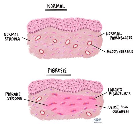 Prevent or Reverse Harmful Fibrosis - by Matt Cook