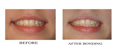 Cosmetic bonding