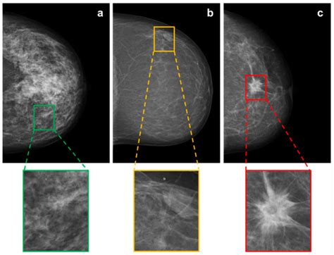 BI-RADS-Based Classification of Mammographic Soft Tissue Opacities ...