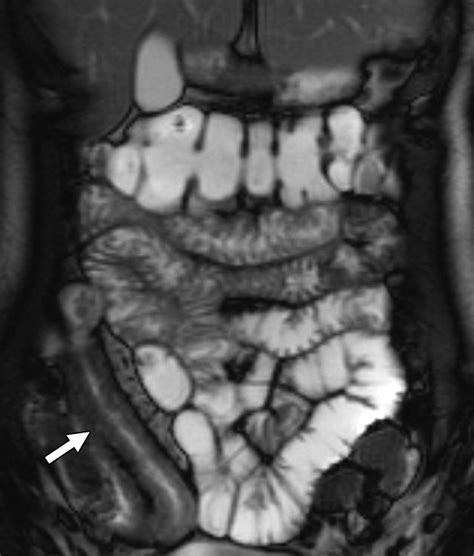 MRI Small-Bowel Follow-Through: Prone Versus Supine Patient Positioning ...