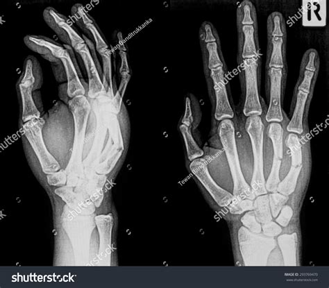 X-Ray Image Of Broken Hand, Ap And Oblique View, Show Metacarpal ...