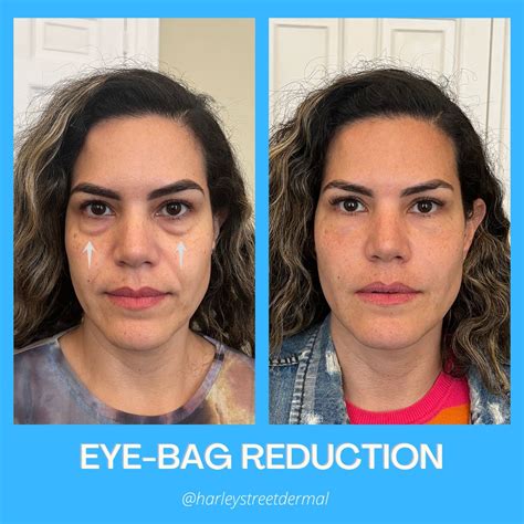 Preparation H For Eye Bags