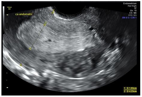 Transvaginal Ultrasound Uterine Cancer Clear Cell Carcinoma Of The