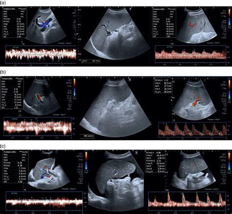 Abnormal Liver Ultrasound Results