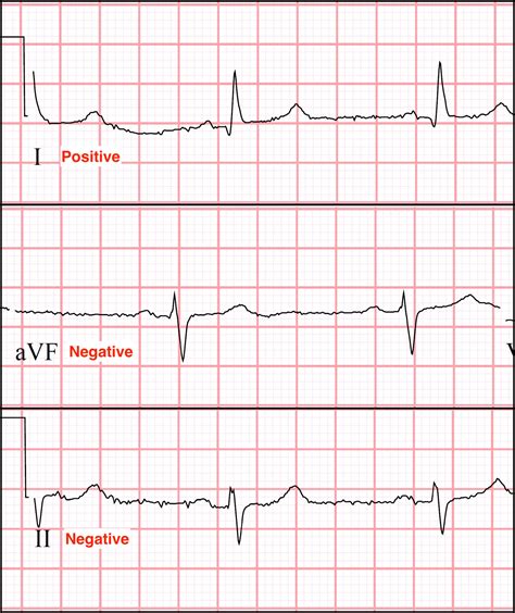 Ecg Axis Deviation Chart : EKG Anatomy/Axis (from Life in the Fast Lane ...