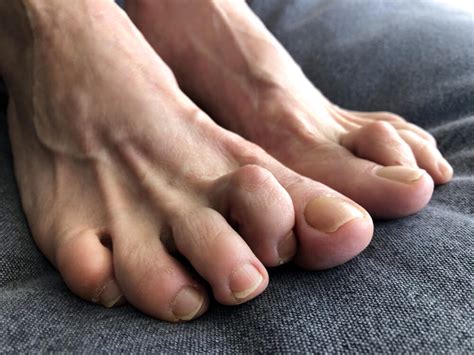 Hammer Toe Relief At Appalachian Foot & Ankle Associates