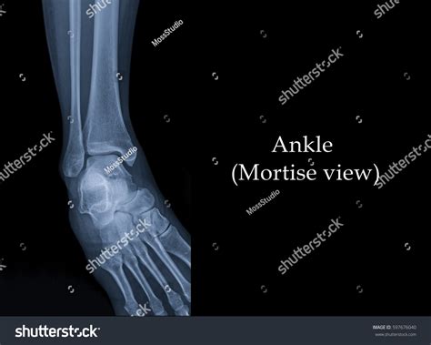 Mortise View Management Of Bone Cyst Of Talar Body By Endoscopic