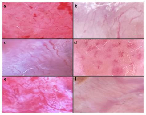 Non-Melanoma Skin Cancer: Dermatoscopic Diagnostic Clues in Mexican ...