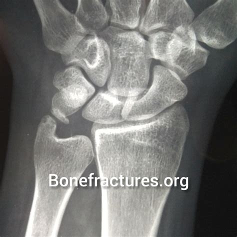 Ulnar impaction syndrome