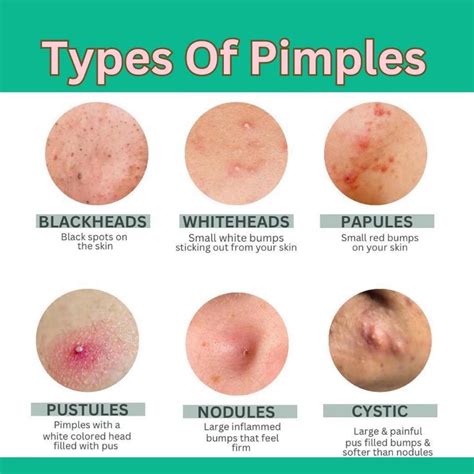 Best 12 5 Things You MUST Know Popping PIMPLES – Artofit