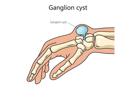 Ganglion Cyst Foot