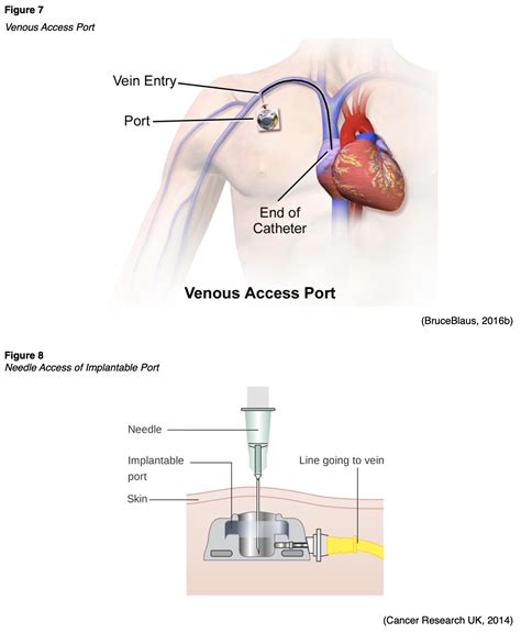 Two Types Of Peripheral Venous Access Device at Odessa Francis blog
