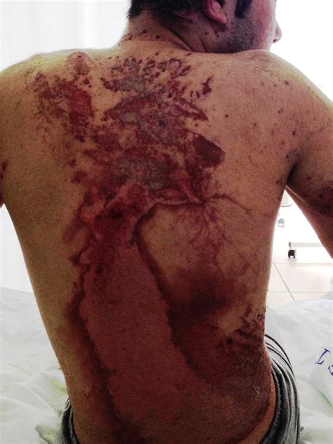 The scar from a lightning strike. These types of scars are called ...