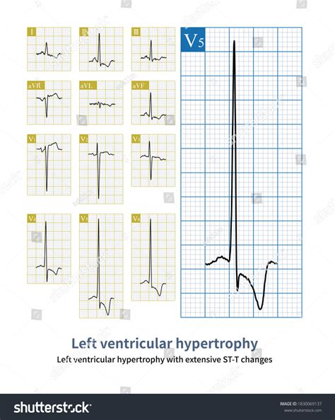 ECG In Left Ventricular Hypertrophy (LVH): Criteria And, 55% OFF