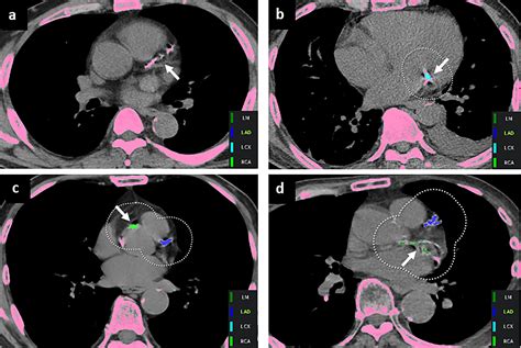 Frontiers | Validation of deep learning-based fully automated coronary ...