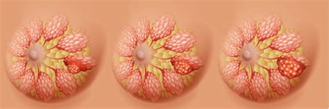 Breast Cancer Diagram In Three Stages | Caas India News
