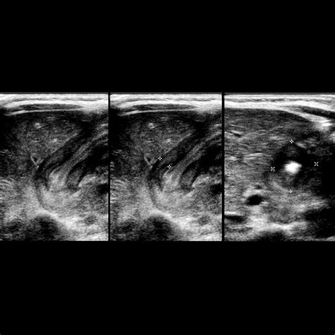 What Does Projectile Vomiting Indicate at Donna Bull blog