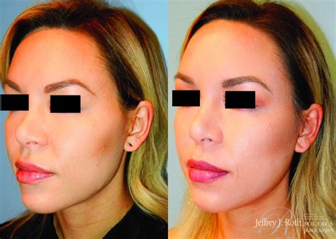 Earlobe Repair Surgery for Las Vegas & Henderson, NV – Board-Certified Plastic Surgeon Dr ...