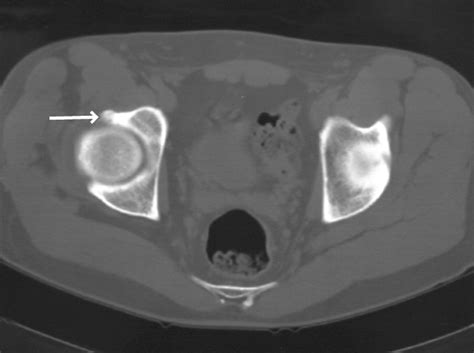 Arthroscopic treatment of femoroacetabular impingement secondary to paediatric hip disorders ...