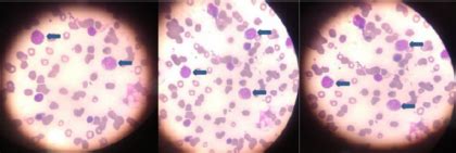 Case of B-cell leukemia presented as inflammatory arthritis: JAPI Case ...