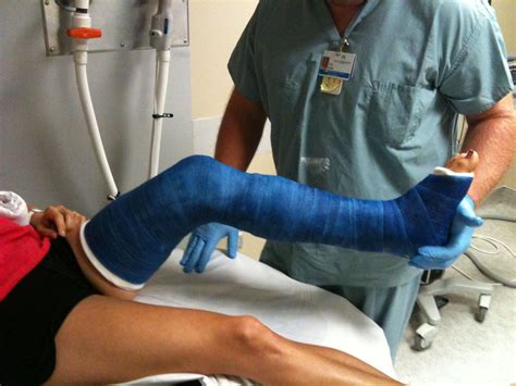 Broken Bones Cast