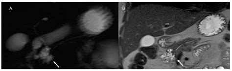Risk Assessment and Pancreatic Cancer: Diagnostic Management and ...