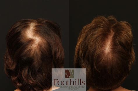 NeoGraft® Before & After Photos Patient 92 | Tucson, AZ | Foothills Facial Plastic Surgery