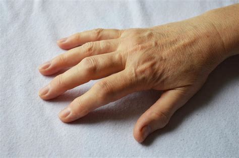 Arthritis in hands: Symptoms, treatment, and home remedies