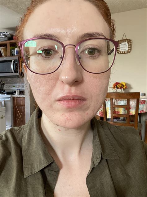 Best procedure to fix my smile, sleep, & dimple wrinkles primarily on the left side of my face ...