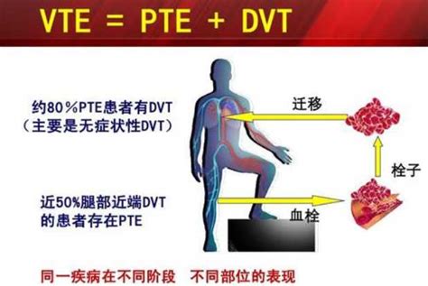 什么是临床上一致公认的VTE防治基础？__中国医疗