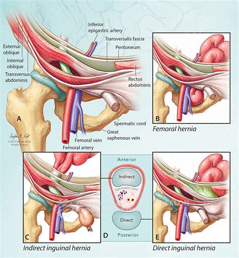 Indirect Vs Direct Hernia
