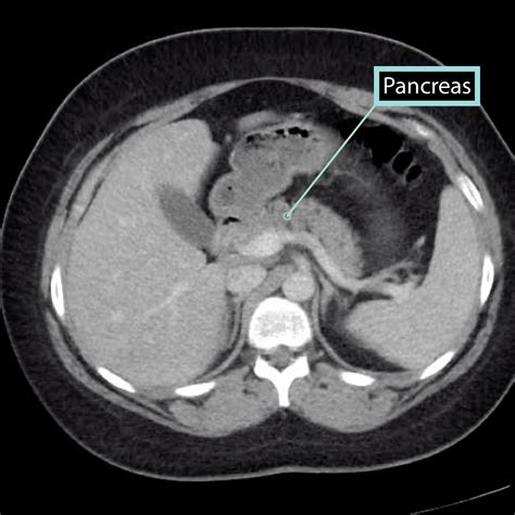 Gross Anatomy Glossary: Pancreas Imaging | ditki medical & biological ...