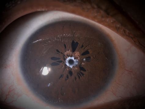 Persistent Pupillary Membrane - EyeWiki