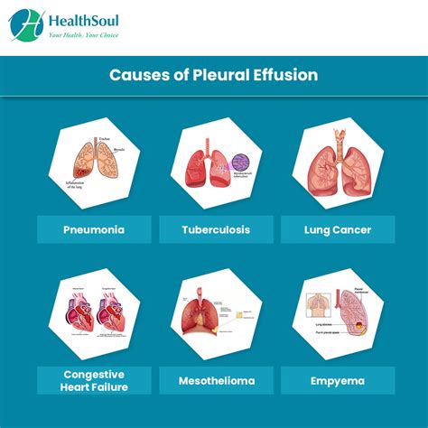 What Is Pleural Rub at Declan Goodisson blog