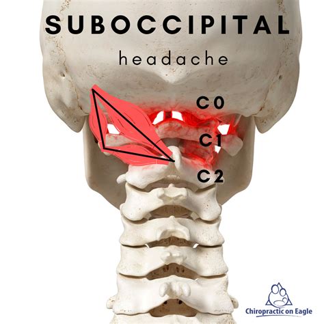 Cervicogenic Headaches - Chiropractic on Eagle, Dr. Jon Saunders
