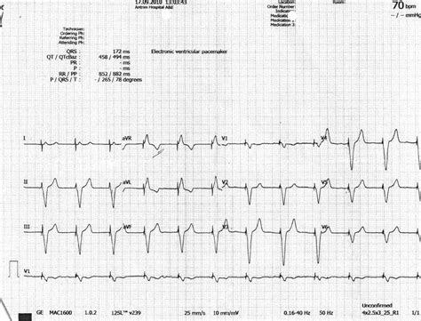 Ventricular Paced Rhythm Solved 35. Rhythm Interpretation . Interpret