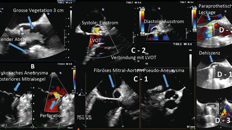 Infektiöse Endokarditis: eine ernst zu nehmende Erkrankung mit schwier ...