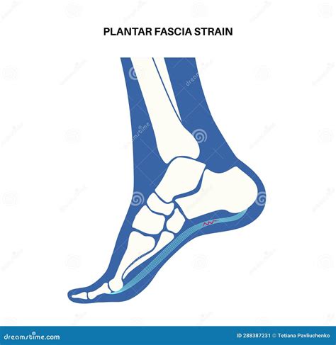 Plantar fascia strain stock illustration. Illustration of feet - 288387231