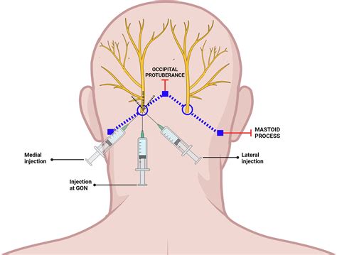 Greater Occipital Nerve Block