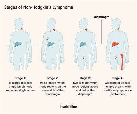 A Visual Guide to Non-Hodgkin’s Lymphoma