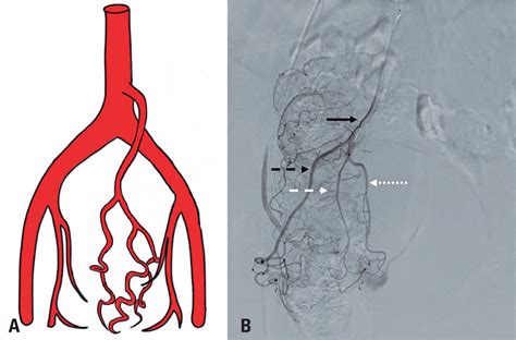 SciELO Brasil - Angiographic description of the superior rectal artery and its anatomical ...