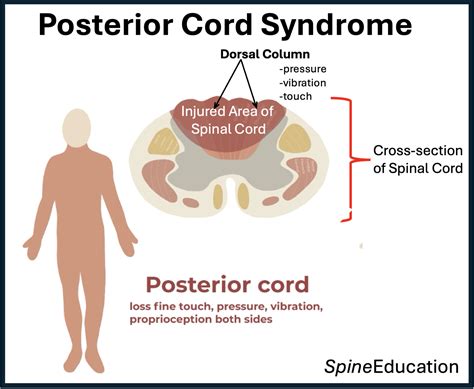 Posterior Cord Syndrome - Spine Education