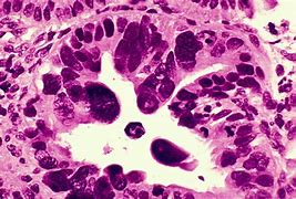 Image result for adenocarcinomas