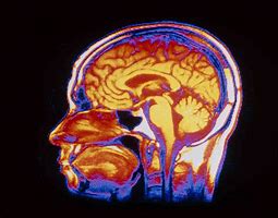 Intracranial 的图像结果